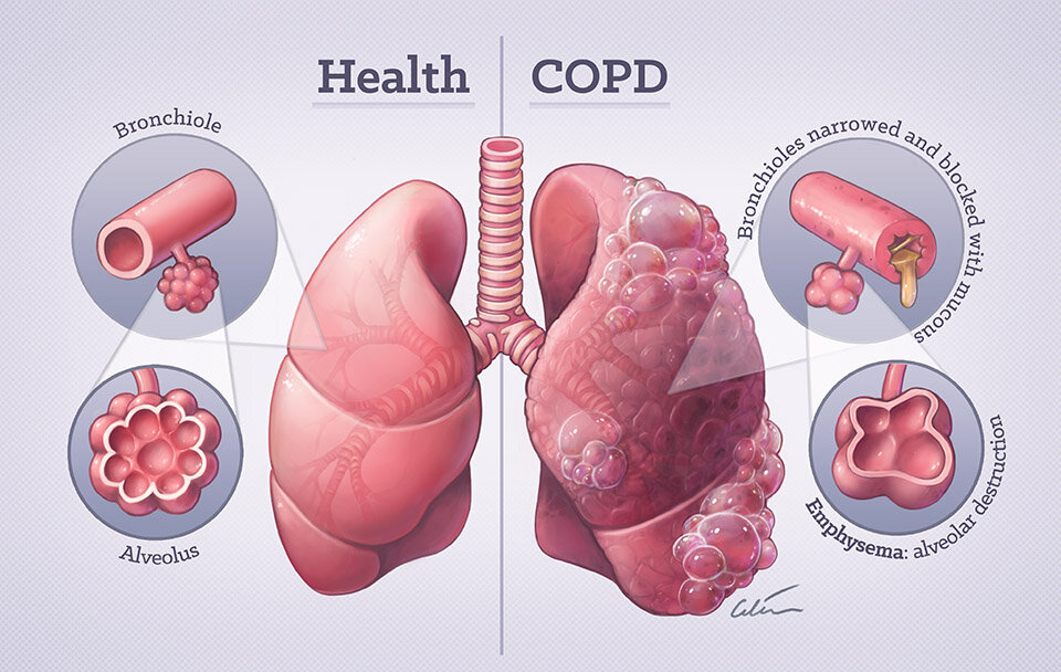 chronic-obstructive-pulmonary-disease-what-you-should-know-infographic