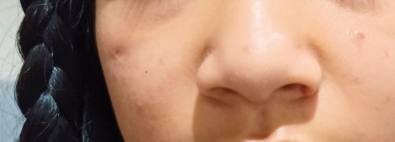 Tiểu phẫu loại bỏ nang/kén thượng bì và nốt ruồi triệt để 8 Tiểu phẫu loại bỏ nang/kén thượng bì và nốt ruồi triệt để