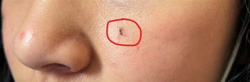 Tiểu phẫu loại bỏ nang/kén thượng bì và nốt ruồi triệt để 7 Tiểu phẫu loại bỏ nang/kén thượng bì và nốt ruồi triệt để