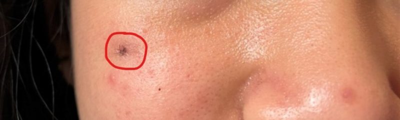 Tiểu phẫu loại bỏ nang/kén thượng bì và nốt ruồi triệt để 6 Tiểu phẫu loại bỏ nang/kén thượng bì và nốt ruồi triệt để
