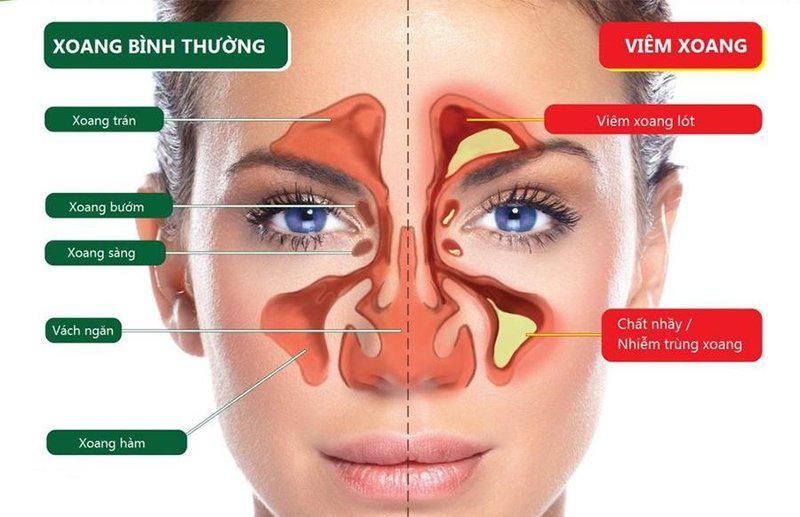 Viêm xoang mạn tính – Nguyên nhân và phác đồ điều trị