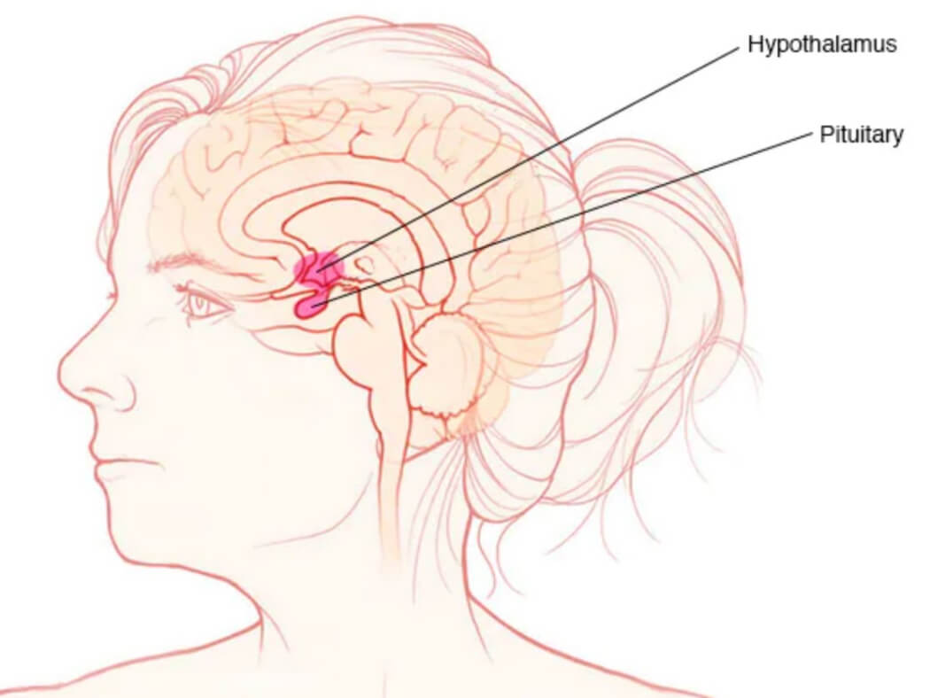 U tuyến yên macroadenoma có thể tái phát không?
