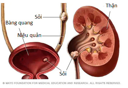 điều trị sỏi thận