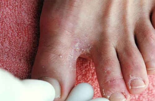 Giày, vớ bị ẩm ướt mùa mưa là môi trường thuận lợi cho nấm kẽ chân phát triển.