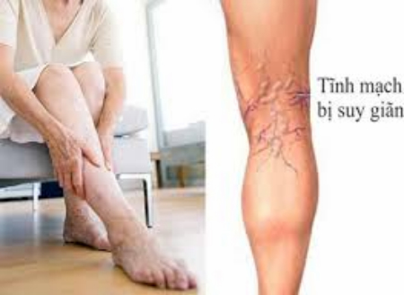 Suy giãn tĩnh mạch có thực sự nguy hiểm? 4 Suy Giãn Tĩnh Mạch