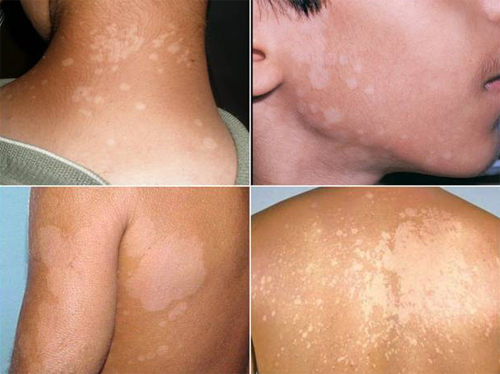 Lang ben do nấm Pityrosporum ovale gây nên, khiến người bệnh ngứa ngáy khó chịu khi đi dưới nắng.