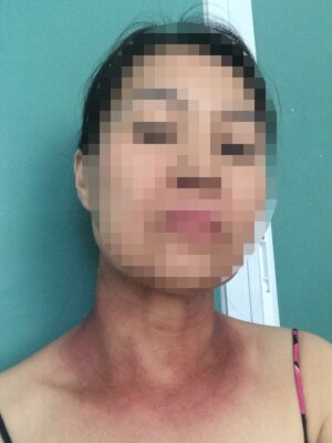 Căn bệnh ung thư mũi họng và cơ hội điều trị lành tại Bệnh viện Raffles Singapore 3 5
