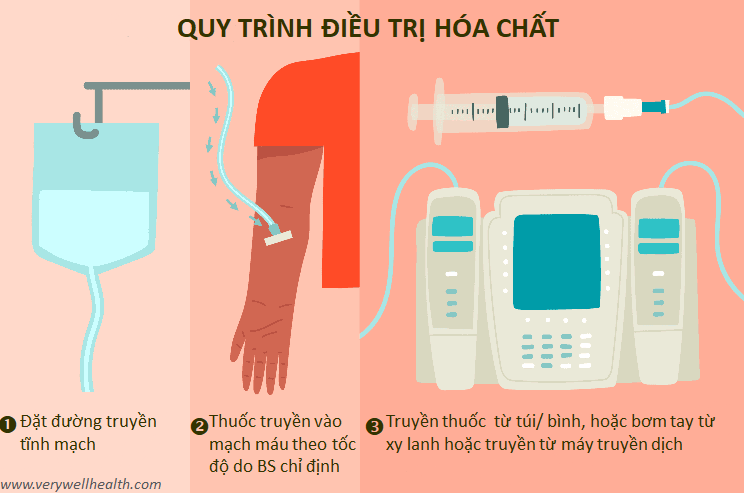 Quy trình điều trị hoá chất (Nguồn: Internet)