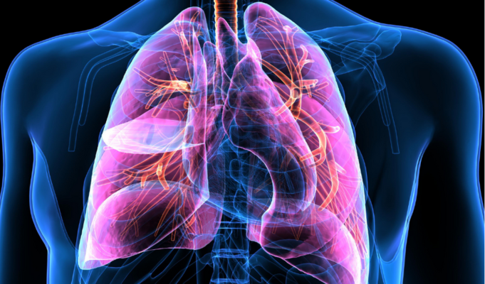 Lung cancer