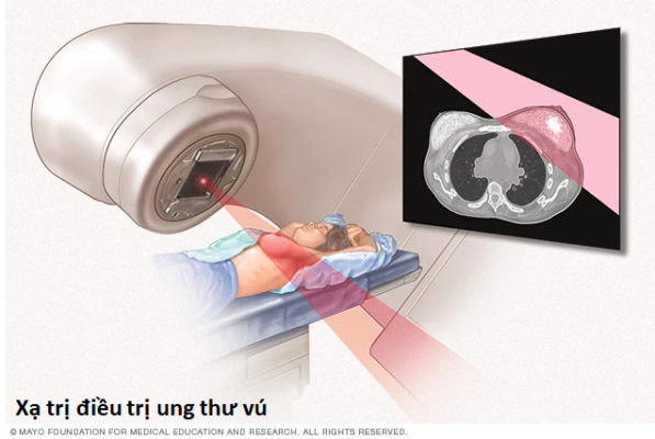 RTx for breast cancer
