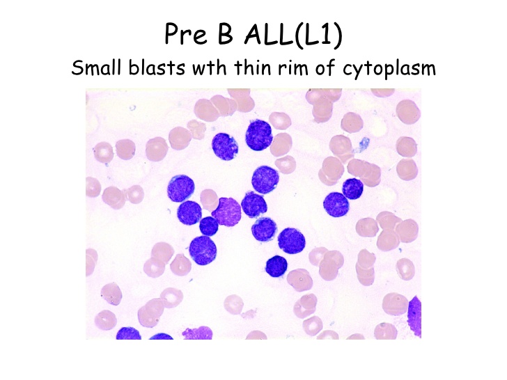 Thuốc nhắm trúng đích mới điều trị Bạch Cầu Lympho Cấp Tính (ALL) 3 acute lymphoblastic leukaemia 12 728
