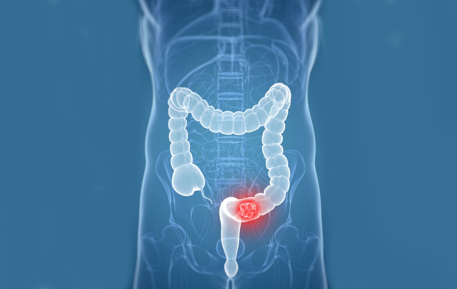 colorectal cancer raffles medical phnompenh