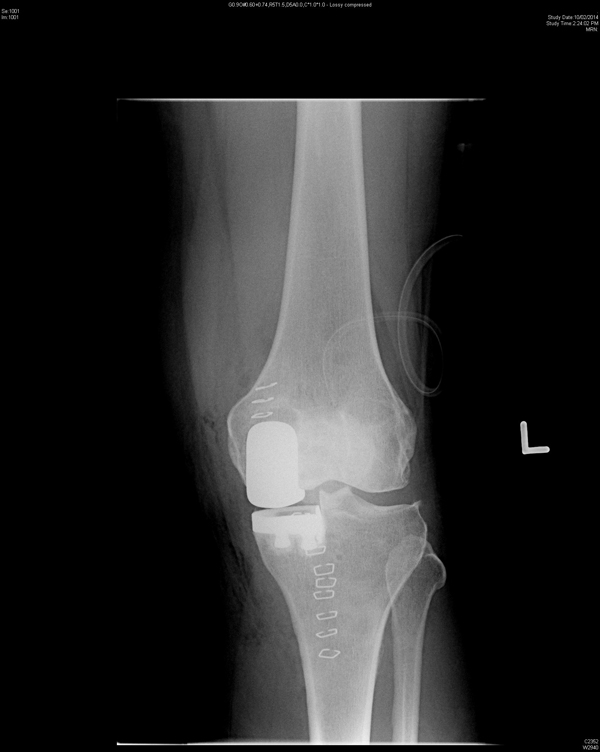 phẫu thuật gối