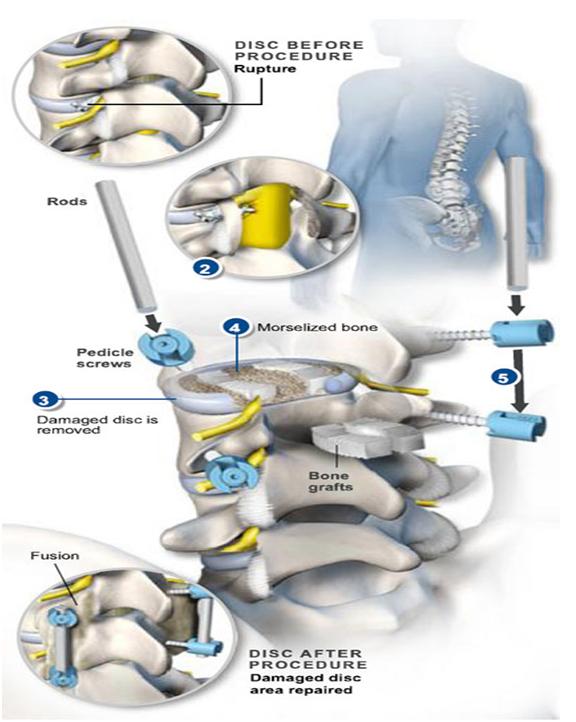 Phương pháp phẫu thuật nẹp cột sống (TLIF) trong điều trị chấn thương chỉnh hình 