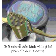Thoát vị đĩa đệm