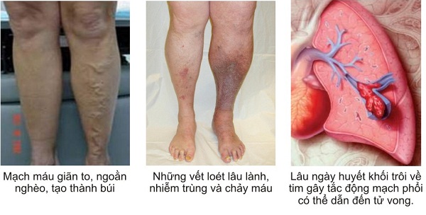 Suy giãn tĩnh mạch có thực sự nguy hiểm? 5 Suy giãn tĩnh mạch có nguy hiểm?