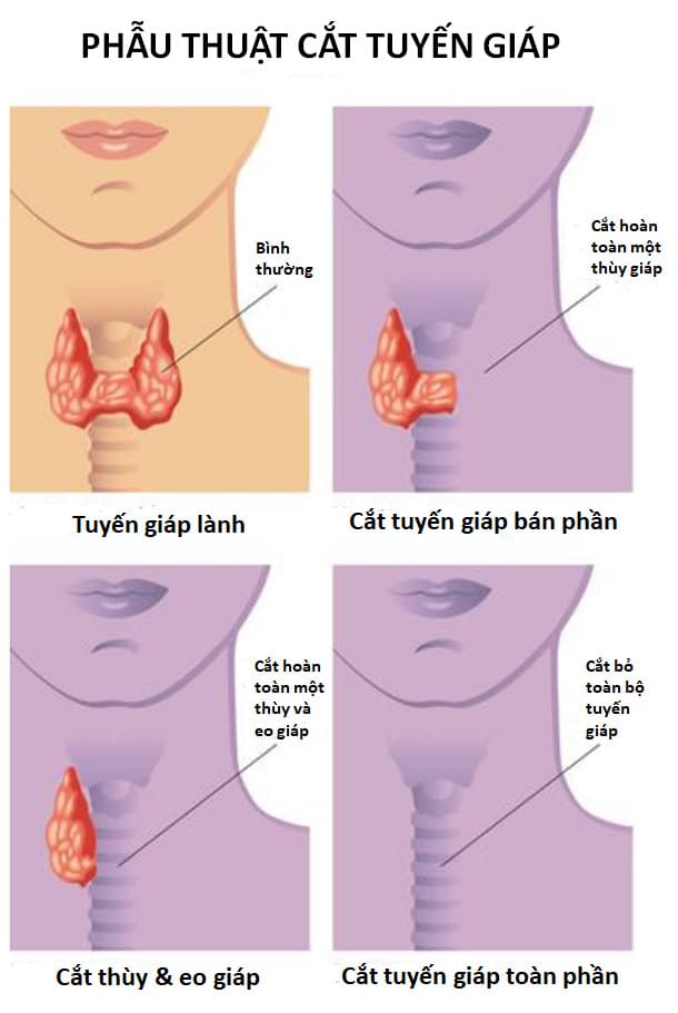 Tìm hiểu về Ung thư Tuyến giáp - Phần 3: Điều trị Ung thư Tuyến giáp và Liệu pháp Iode Phóng xạ 9 Điều trị Ung thư Tuyến giáp bằng phẫu thuật cắt tuyến giáp toàn phần hoặc phẫu thuật cắt tuyến giáp bán phần
