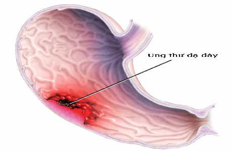 Ung thư dạ dày và cách điều trị 3 ung thu da day