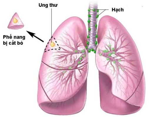 ung thu phoi singapore
