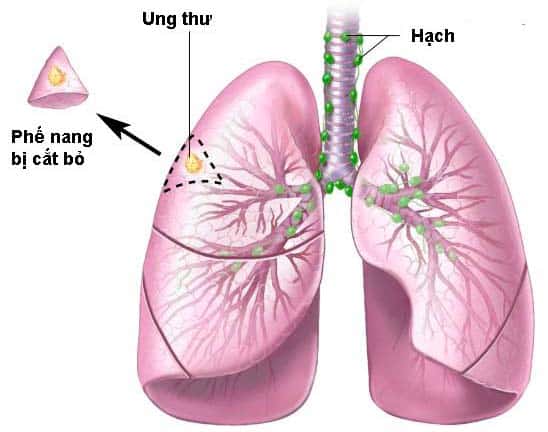 Điều trị ung thư phổi tại bệnh viện Raffles Singapore 3 Ung thư phổi