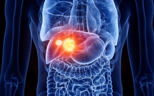 Ung thư gan (Nguồn: Internet)