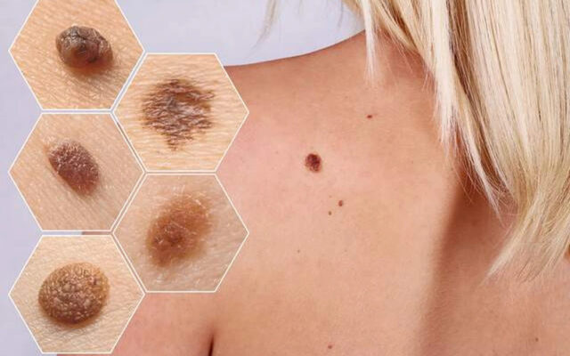 Ung thư da (Nguồn: Internet)