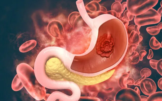 Ung thư dạ dày (Nguồn: Internet)