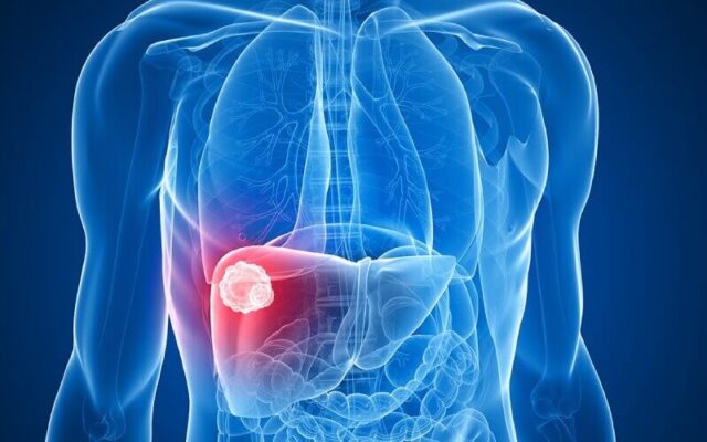 Ung thư gan giai đoạn cuối (Nguồn: Internet)
