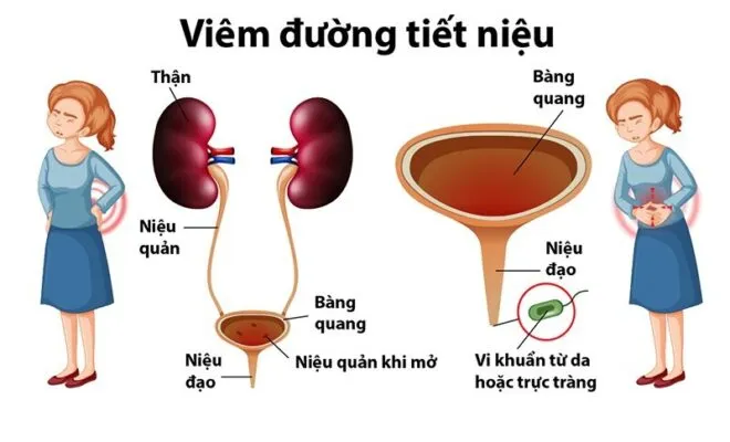 Nguyên nhân gây viêm đường tiết niệu (Nguồn: Internet)