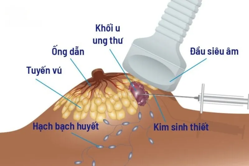 Sinh thiết (Nguồn: Internet)