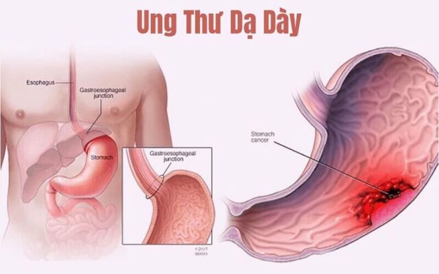 Ung thư dạ dày (Nguồn: Internet)