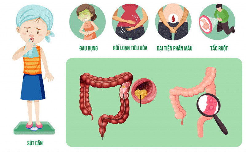 8 dấu hiệu ung thư đại tràng 10 dau hieu ung thu dai trang 2