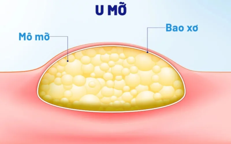 U mỡ (Nguồn: Internet)