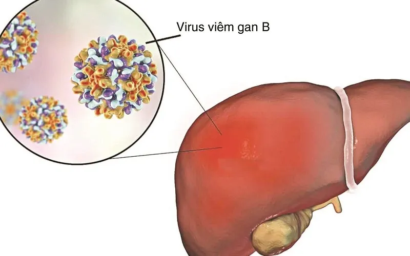 Viêm gan B (Nguồn: Internet)