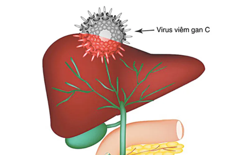 Viêm gan virus (Nguồn: Internet)