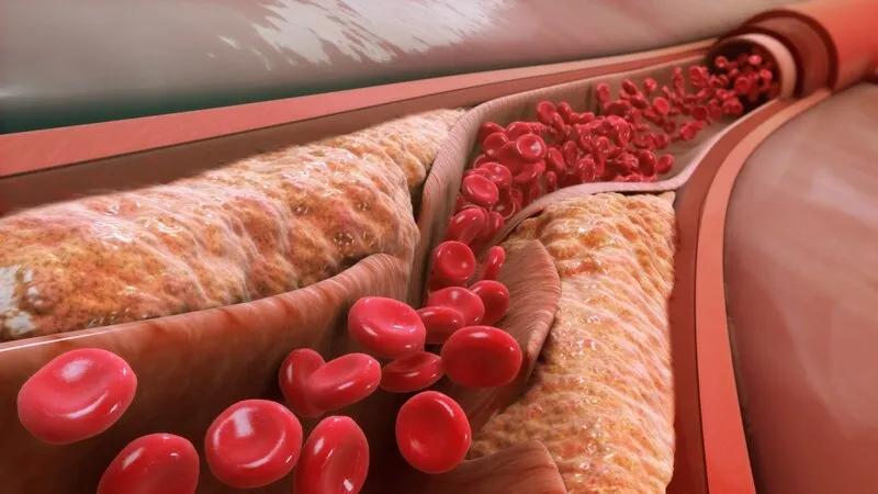 Mức cholesterol cao có thể gây bệnh mạch vành (Nguồn: Internet)