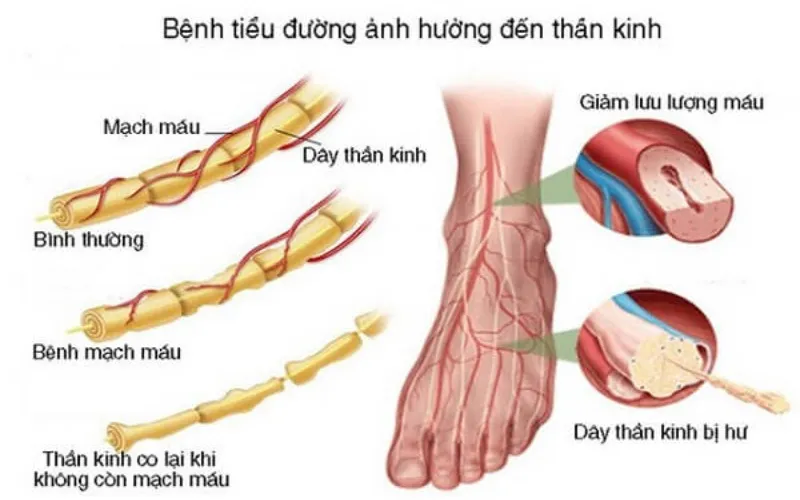 Nguyên nhân gây bệnh thần kinh ngoại biên (Nguồn: Internet)