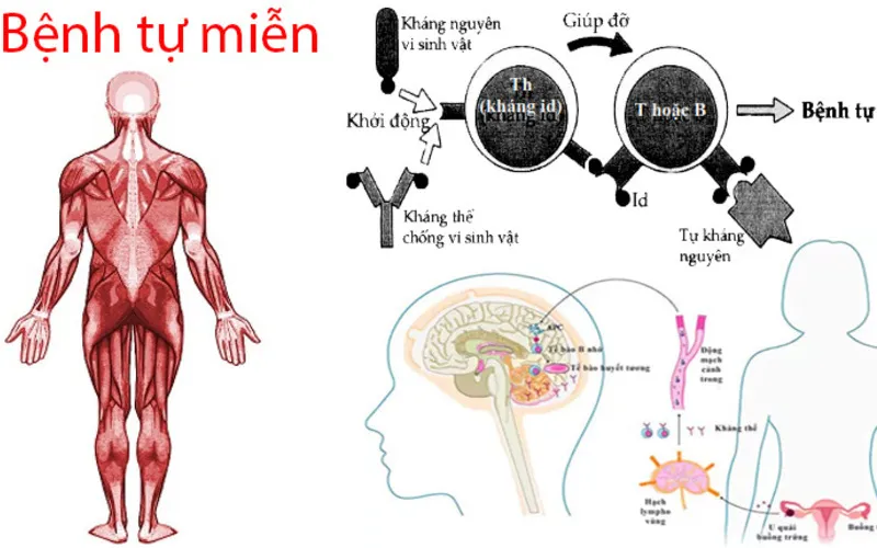 Bệnh tự miễn là gì? (Nguồn: Internet)