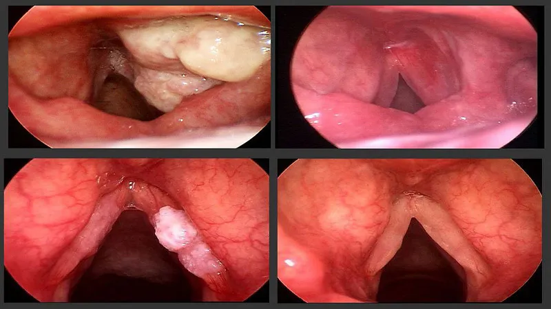 Các dấu hiệu ung thư thanh quản thường gặp (Nguồn: Internet)