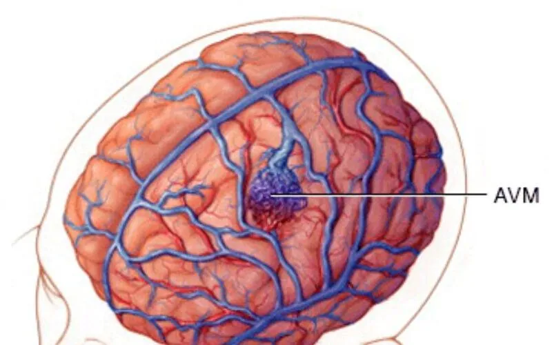 Yếu tố ảnh hưởng đến việc dị dạng mạch máu não có chữa được không (Nguồn: Internet)