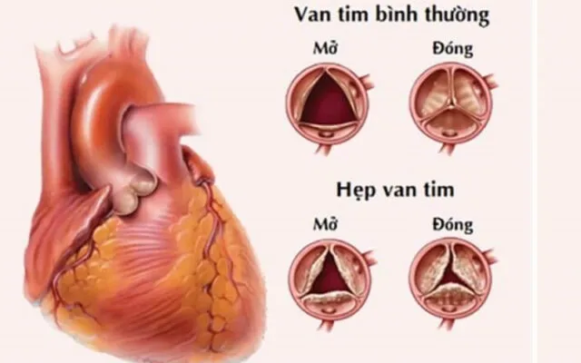 Hẹp van tim là gì? (Nguồn: Internet)