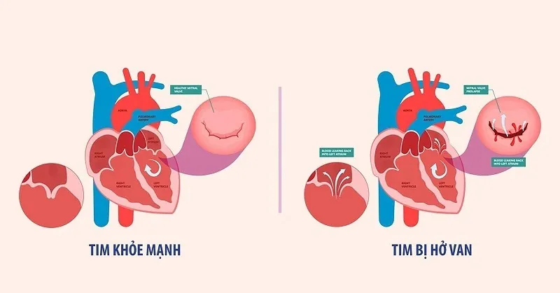 Hở van tim là gì? (Nguồn: Internet)