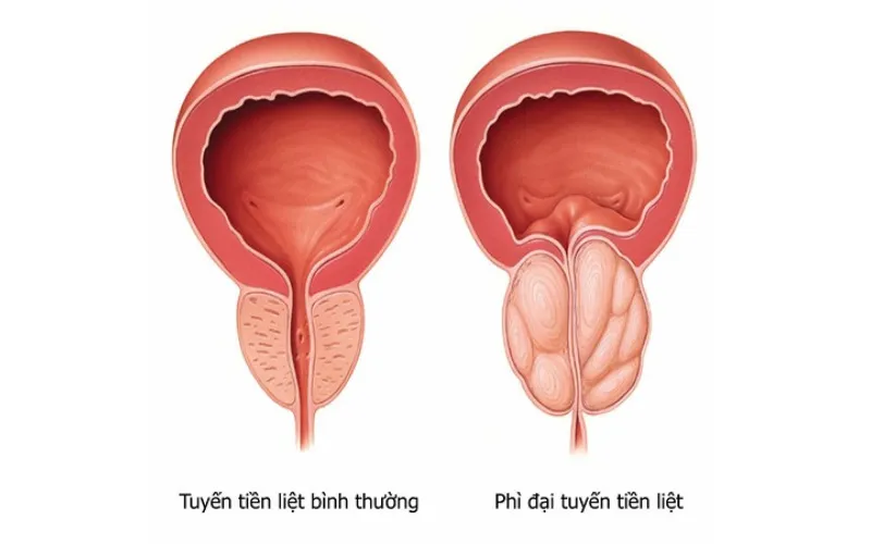 U tuyến tiền liệt là gì? (Nguồn: Internet)