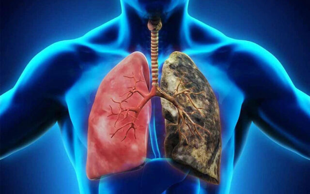 Tìm hiểu về ung thư phổi giai đoạn 3 (Nguồn: Internet)