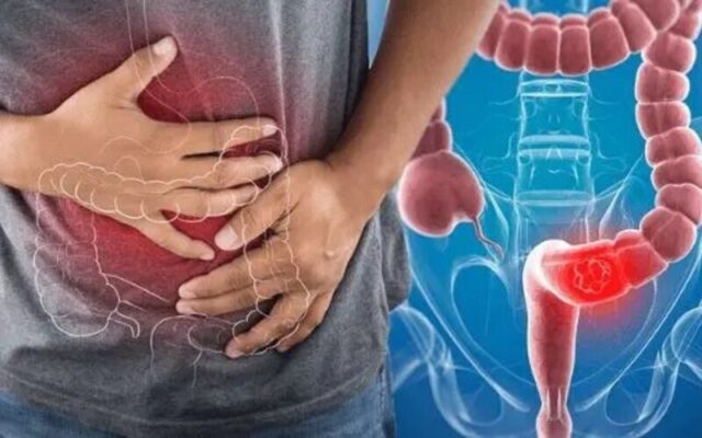 Có thể điều trị ung thư trực tràng không? (Nguồn: Internet)