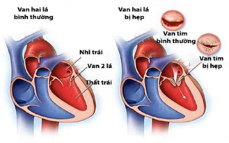 Hẹp van 2 lá là gì? (Nguồn: Internet)