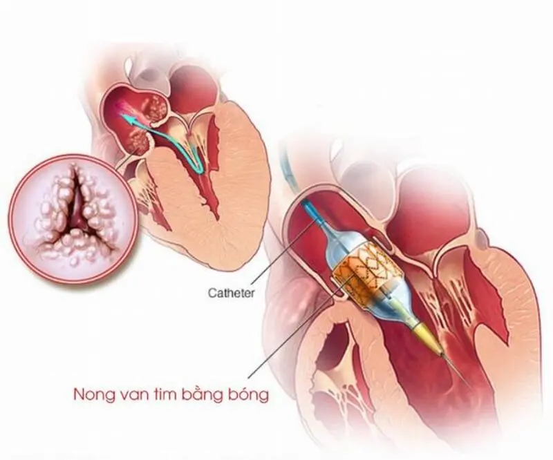 Nong van hai lá bằng bóng qua da (Nguồn: Internet)