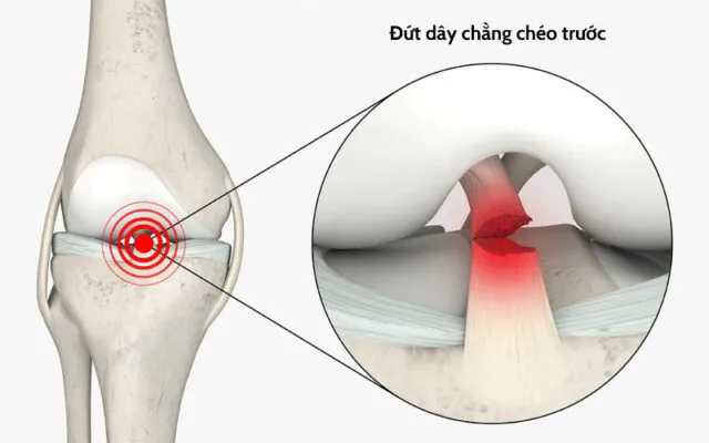 Đứt dây chằng khiến khớp tổn thương (Nguồn: Internet)