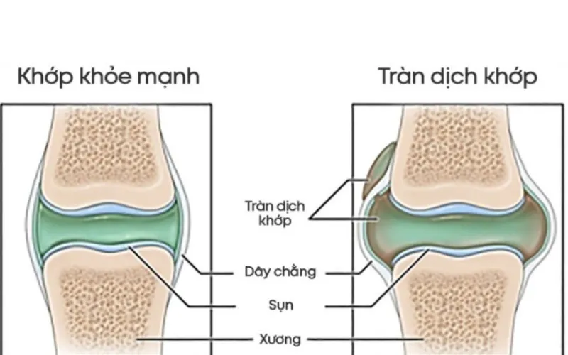 Tràn dịch khớp gối là gì? (Nguồn: Internet)