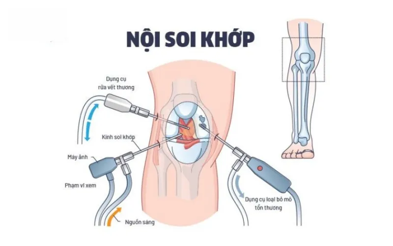 Phẫu thuật nội soi phương pháp mổ tràn dịch khớp gối(Nguồn: Internet)